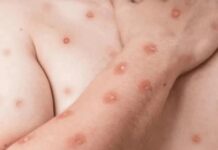 No Brasil, casos confirmados de Mpox chegam a 140